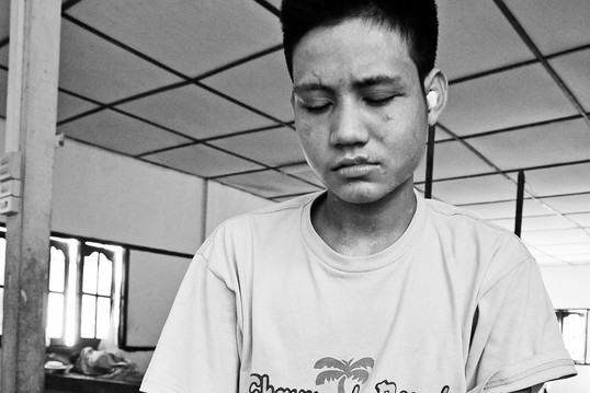 Naing Htoo mit Narben im Gesicht.